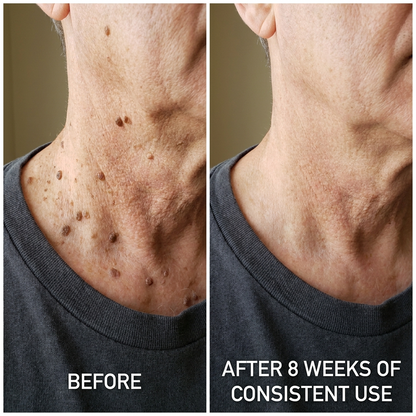 Advanced Keratolytic Cream For Rough, Raised Seborrheic Keratoses